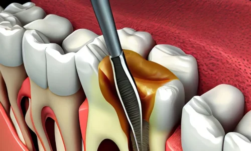 root-canal-treatment-101-banner